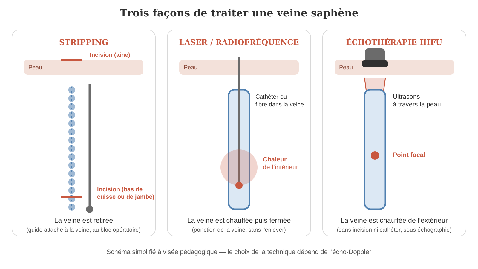 Schéma comparant le stripping, le laser ou la radiofréquence et l’échothérapie HIFU