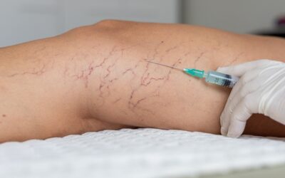 Sclérothérapie des varices : principe, indications et limites